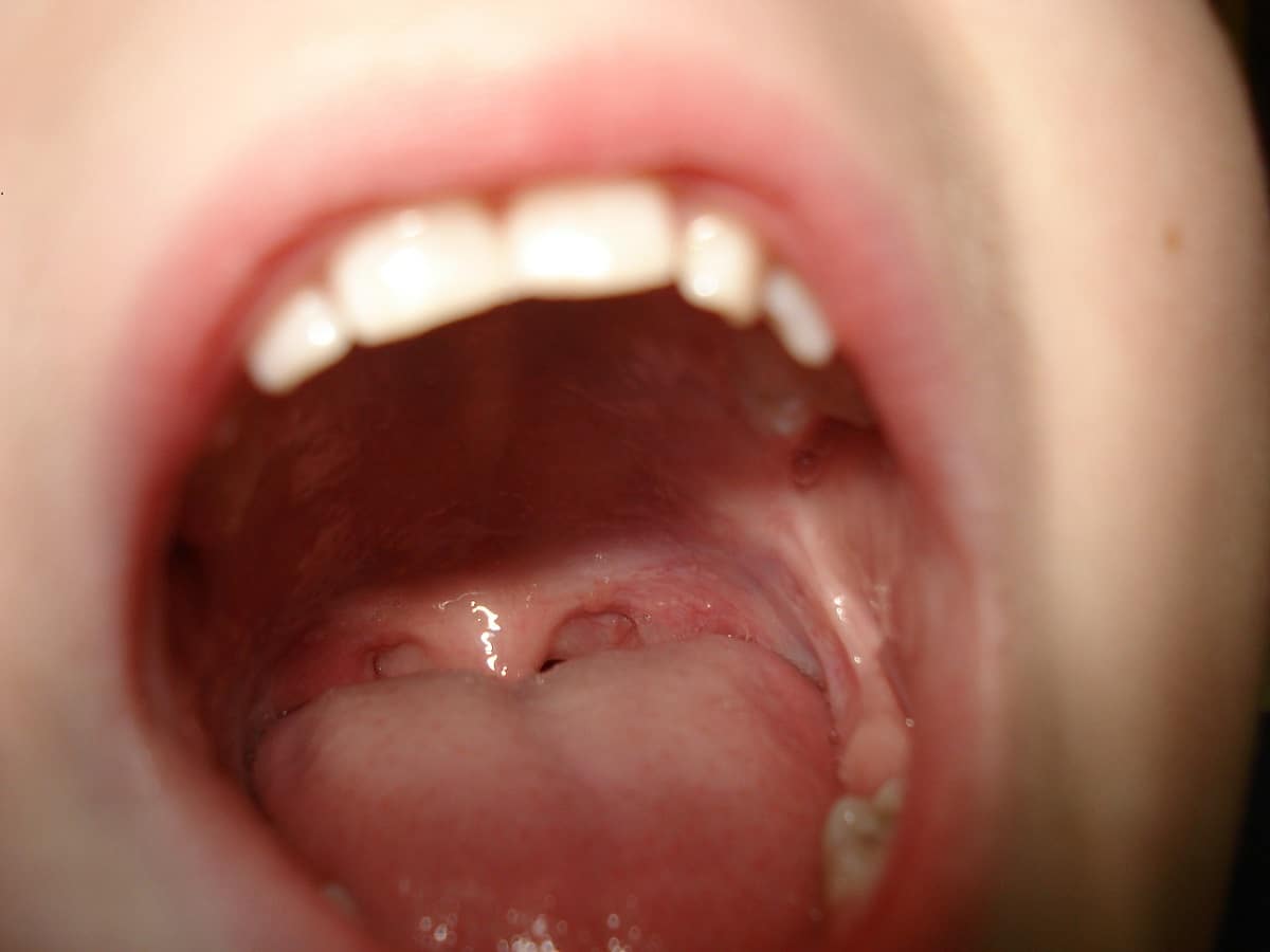 Eliminar bacterias de la lengua